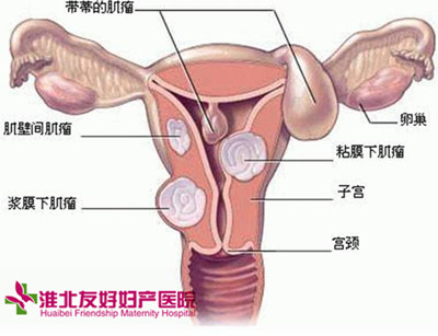 不及時治療盆腔炎危害大