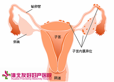 子宮內(nèi)膜炎患者要做哪些檢查