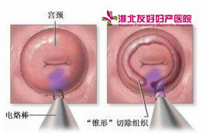 得了宮頸肥大會(huì)有什么表現(xiàn)