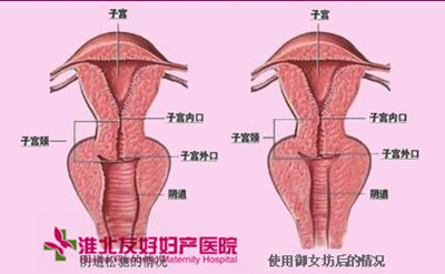 宮頸肥大患者會(huì)有哪些典型癥狀