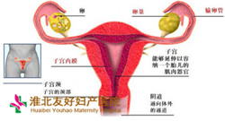 為什么有宮頸息肉