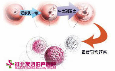 宮頸糜爛是哪些原因造成的