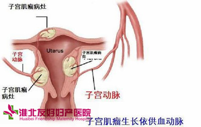 怎樣得知自身患子宮肌瘤