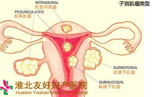 子宮肌瘤什么時候切