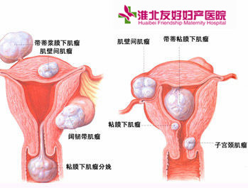 子宮肌瘤的產(chǎn)生原因