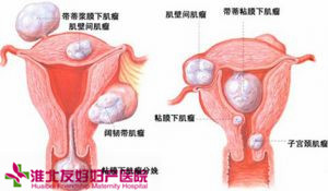 子宮肌瘤手術(shù)多少錢