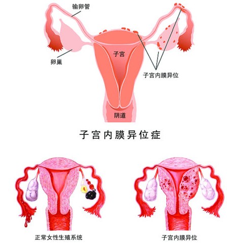 子宮內(nèi)膜異位癥引起女性不孕的原因